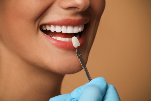 Can Dental Veneers Fix Chipped, Stained, Or Uneven Teeth?