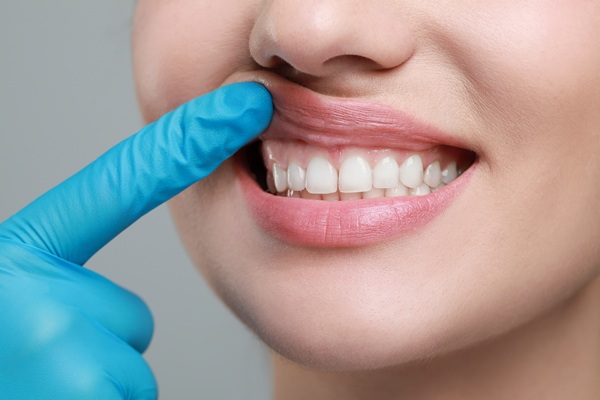 What Gum Disease Looks Like